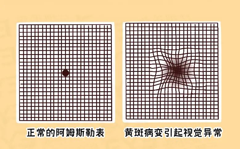 视物扭曲了？小心得了黄斑病变！插图(3)