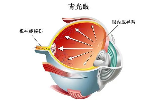 眼病也有“性别歧视”？女性应谨防这几种眼病插图(1)