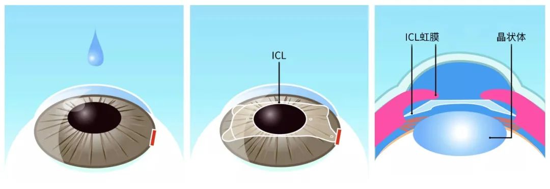 为什么说ICL是近视手术的“天花板”？湘潭做ICL怎么选择？插图