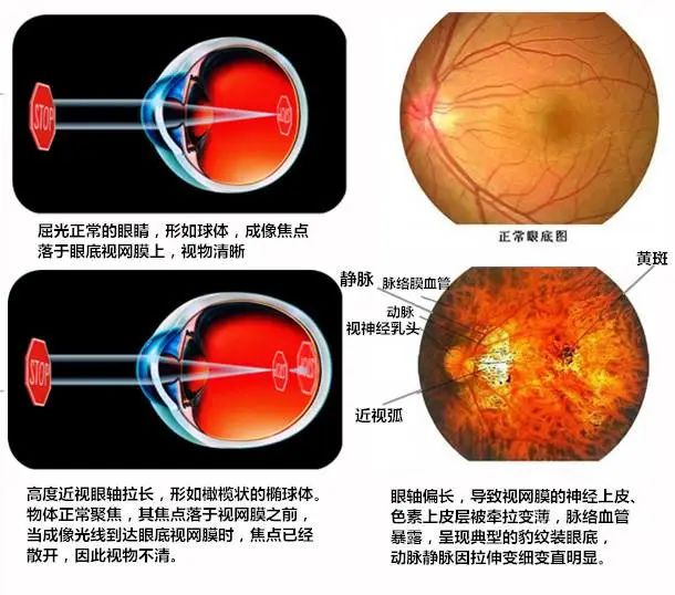 近视度数也分级别？这类人这项检查要定期做！插图(3)