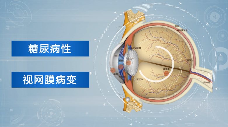 真的吗？糖尿病可能会致盲？插图(1)