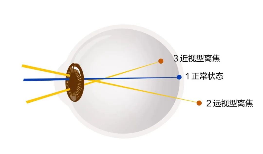 对“离焦眼镜”你了解多少，它为什么能延缓近视的发展？插图