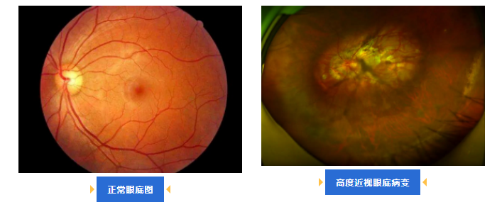 春暖花开日，护眼正当时，今年的眼底检查你做了吗？插图(2)