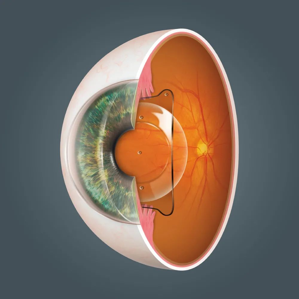 ICL在眼内可以管一生吗？插图(2)