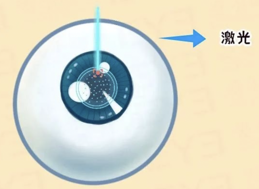 散光+近视，做近视手术时能一并解决吗？插图(1)