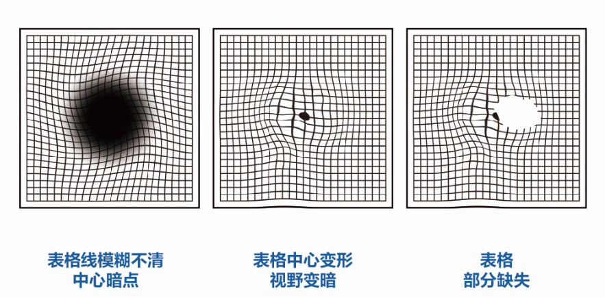 一张方格表，可测眼底黄斑健康？插图(1)