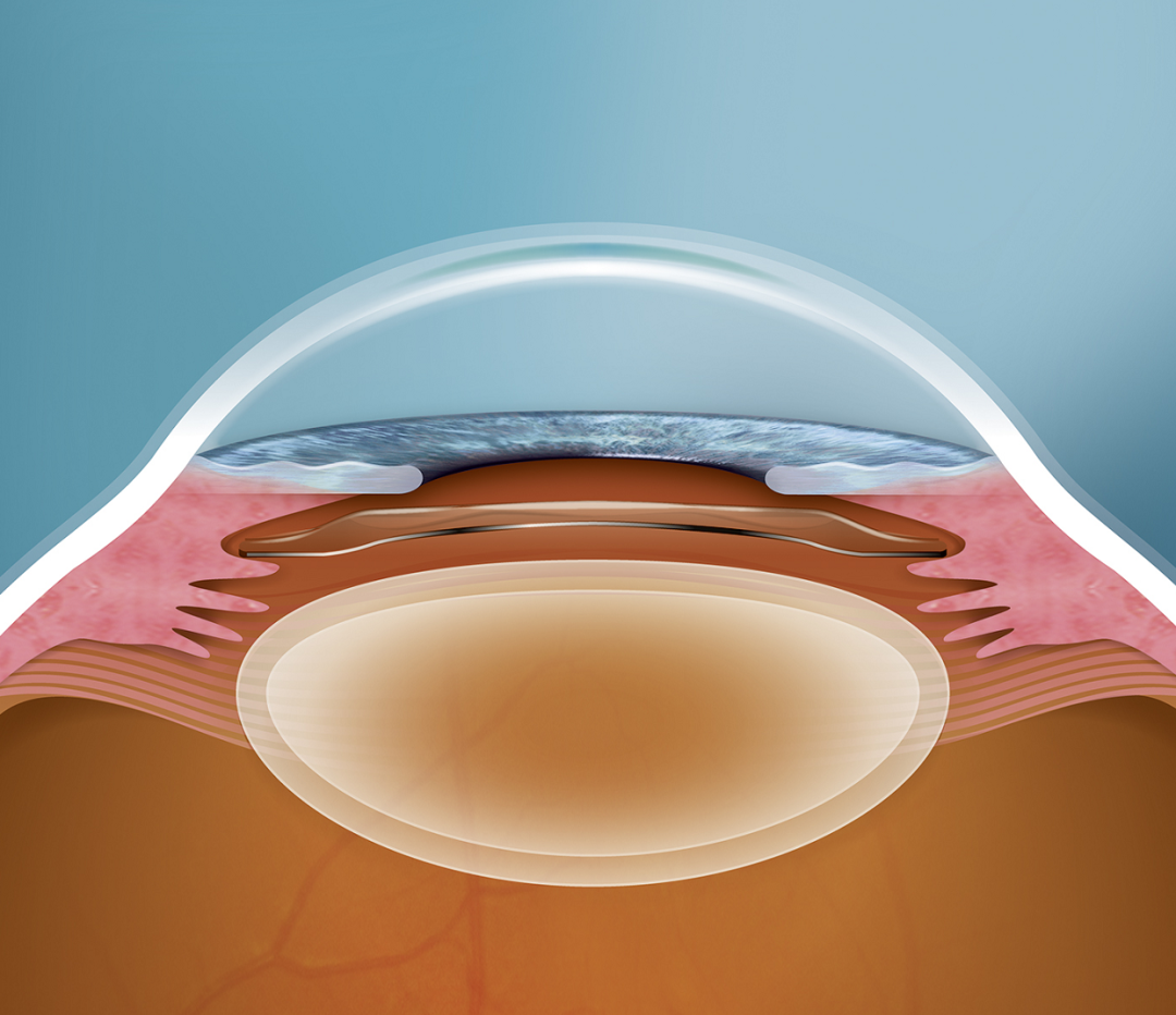ICL晶体植入手术有没有后遗症？插图