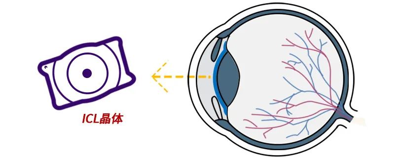 ICL晶体植入手术有没有后遗症？插图(2)