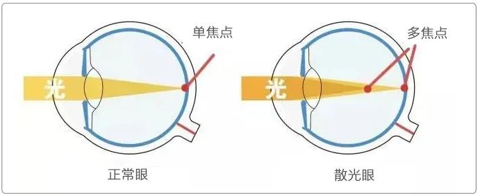 近视手术做完，散光怎么办？插图