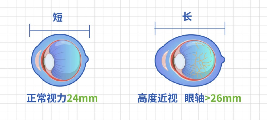 高度近视患者，眼部并发症的”避坑”指南来了~插图