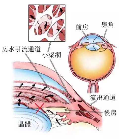 都知道高血压不好，但高眼压更麻烦插图