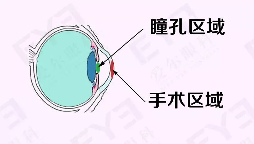 近视手术后，还能正常的健身和做其他运动吗？插图