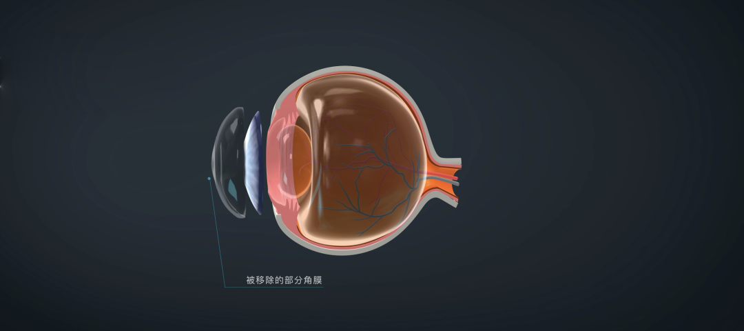 现在做近视手术，20年后会怎么样？插图