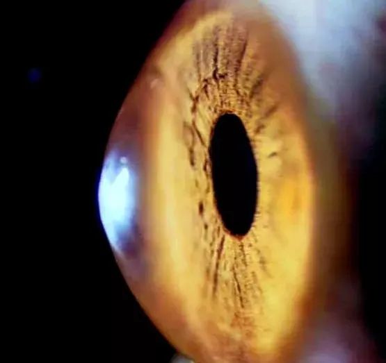 圆锥角膜是个什么眼病？为什么不能做激光近视矫正？插图