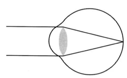 屈光不正，就是近视眼吗？插图(1)