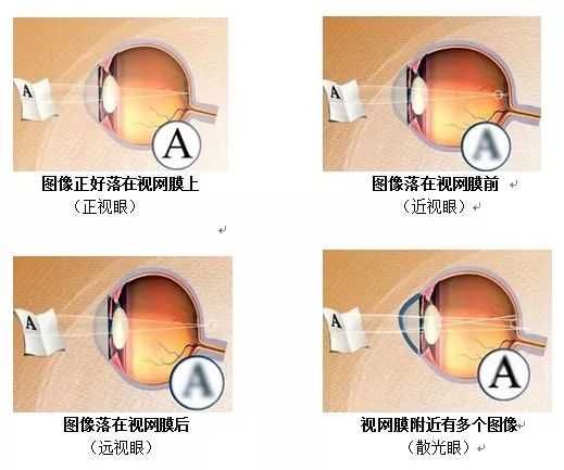 屈光不正，就是近视眼吗？插图(2)