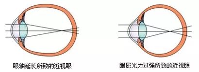 屈光不正，就是近视眼吗？插图(3)