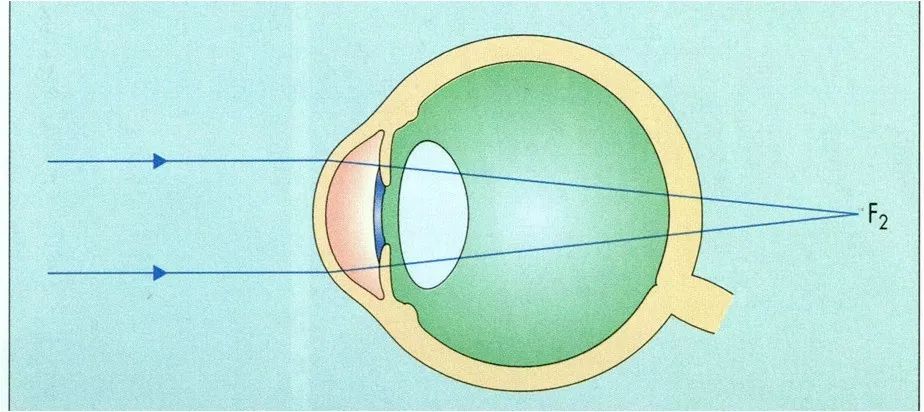 屈光不正，就是近视眼吗？插图(4)