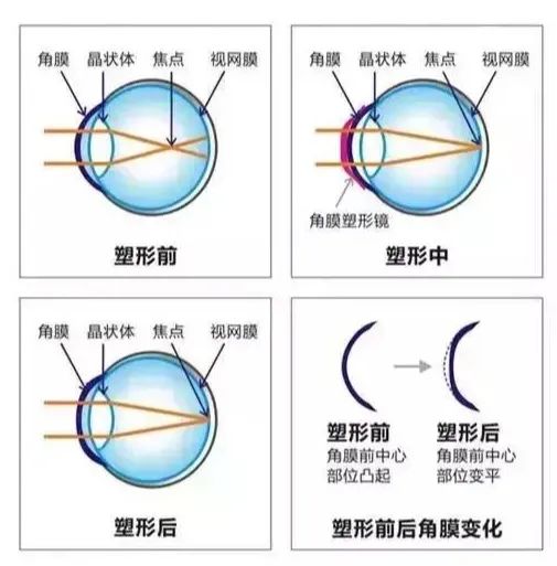 睡觉时“重塑”眼睛？角膜塑形镜到底是个什么原理？插图(1)