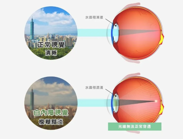 得了白内障不做手术会怎么样?插图(1) 得了白内障不做手术会怎么样?插图(1)
