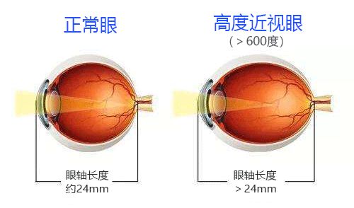 致盲性眼病年轻化，该如何应对？插图