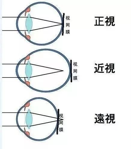 不要等孩子近视了才来看医生插图