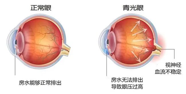 白内障竟会拖延出青光眼？插图(1)