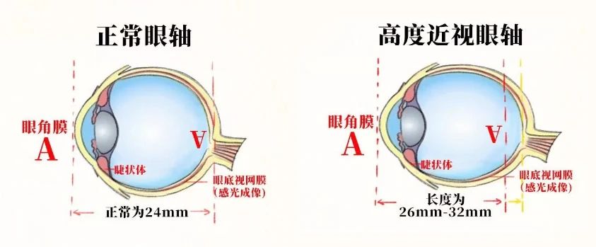 警惕这些高度近视的并发症，严重可致盲！插图