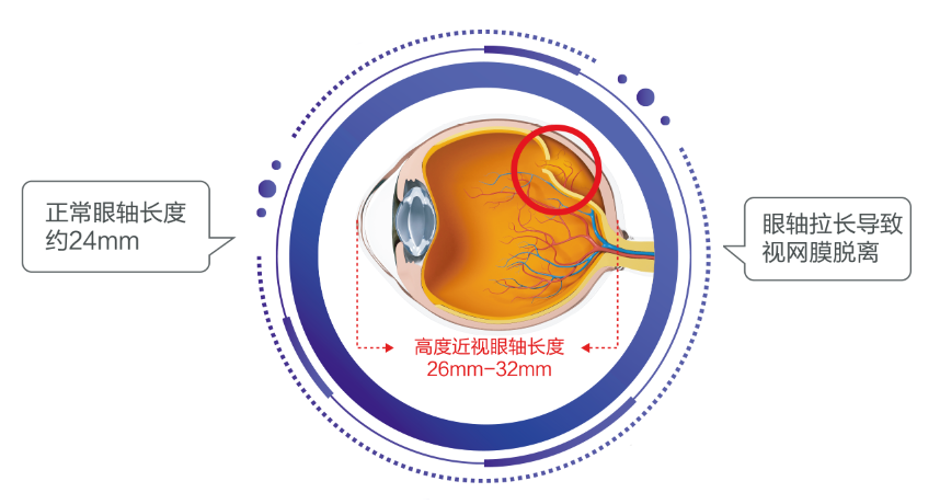 警惕这些高度近视的并发症，严重可致盲！插图(1)