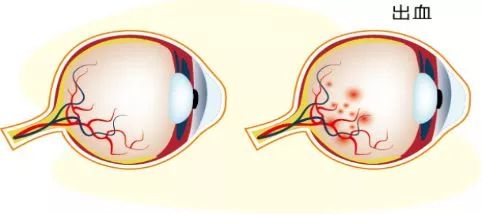 眼底出血和眼睛充血是一回事吗？插图(2)