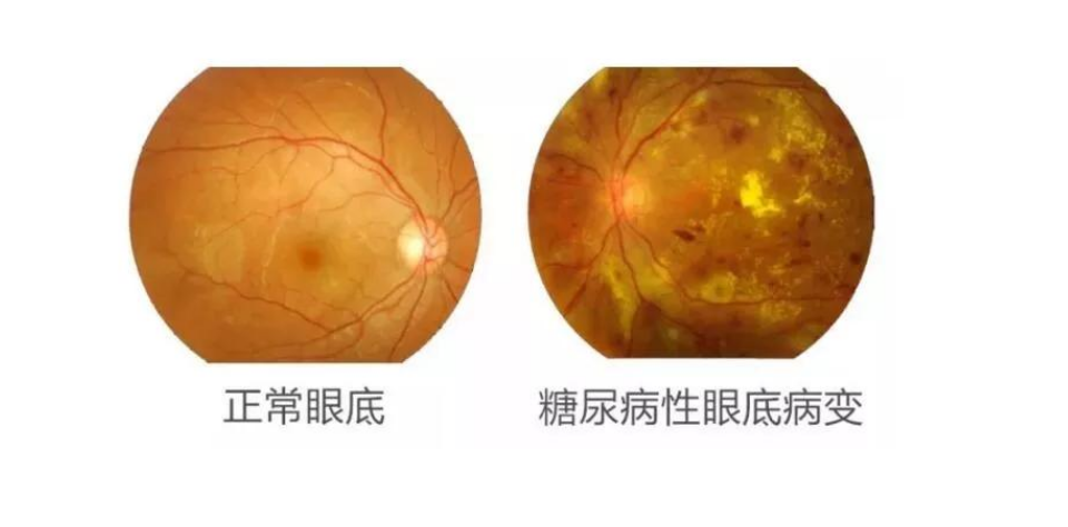 人老眼花？小心视力这张“网”，早筛早治很重要插图