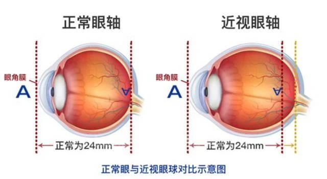 单眼近视和双眼近视哪种危害更大？插图(1)