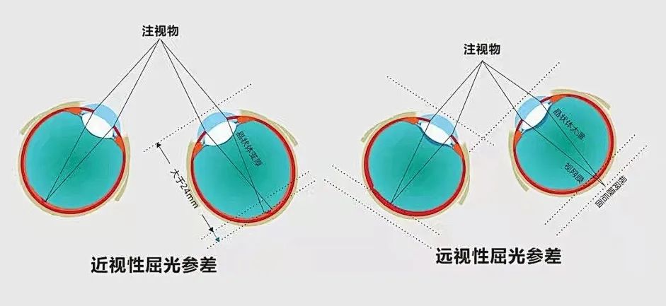 单眼近视和双眼近视哪种危害更大？插图(2)