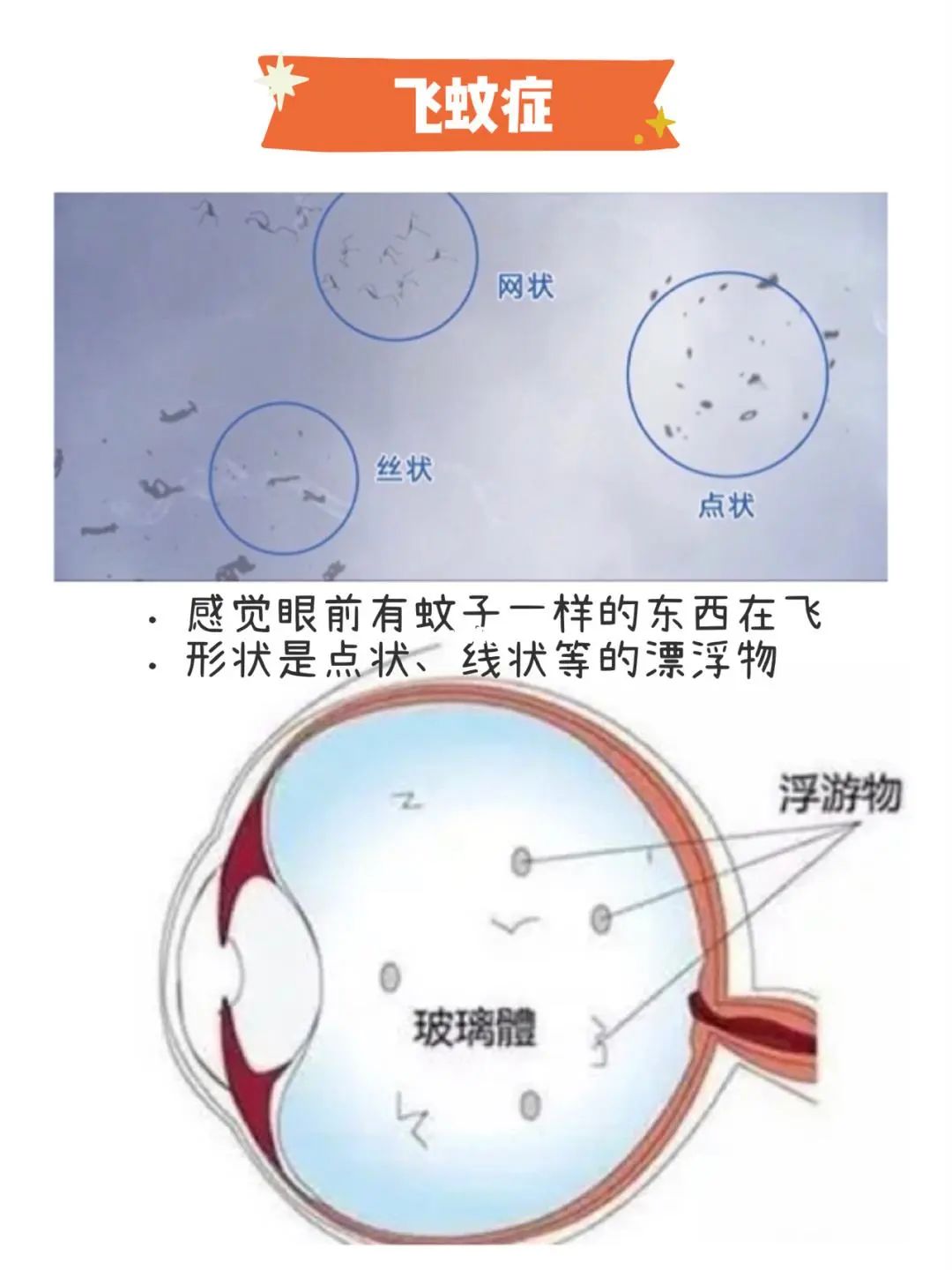 救命！眼睛里有好多只找不到的蚊子？！插图(1)