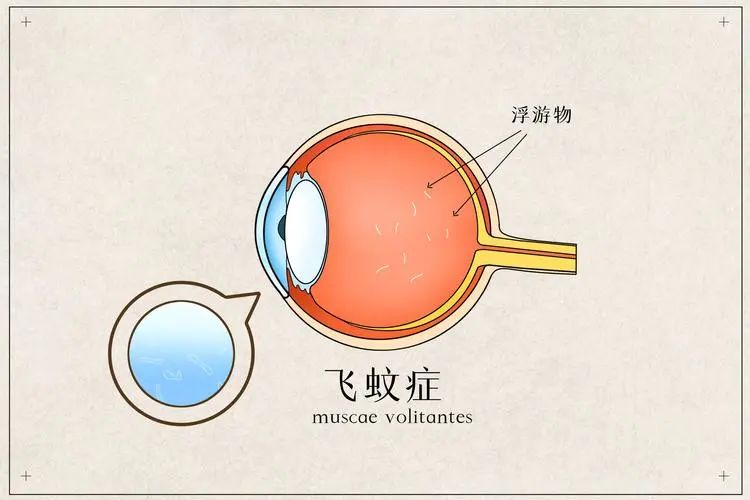 救命！眼睛里有好多只找不到的蚊子？！插图(2)