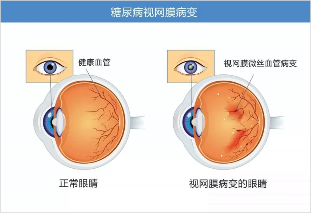 定期的眼底检查，该怎么查？什么人群需注意？插图