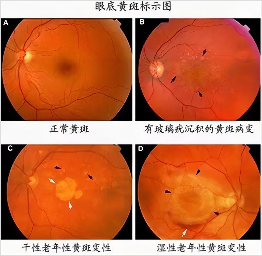 定期的眼底检查，该怎么查？什么人群需注意？插图(3)