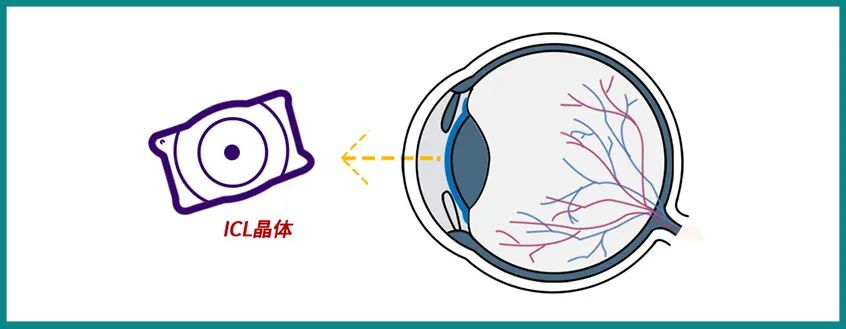 只有高度近视才能做ICL？关键得看这3个条件…插图(1)