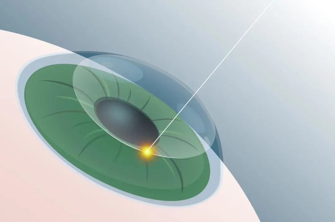 近视手术长期有效吗？手术后如何护理眼睛？插图