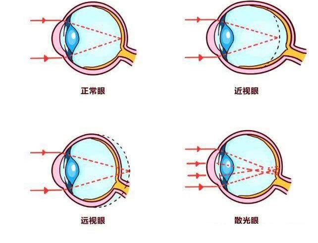 近视到底能不能治愈？这篇文章说明白了插图