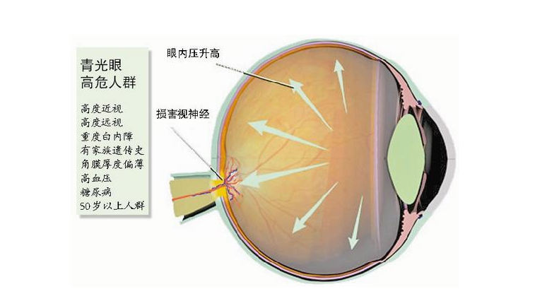 做完青光眼手术后，应该注意什么？超实用插图