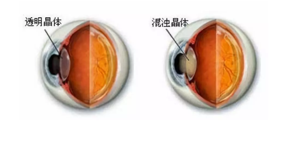 老年人，如何科学治疗白内障？插图
