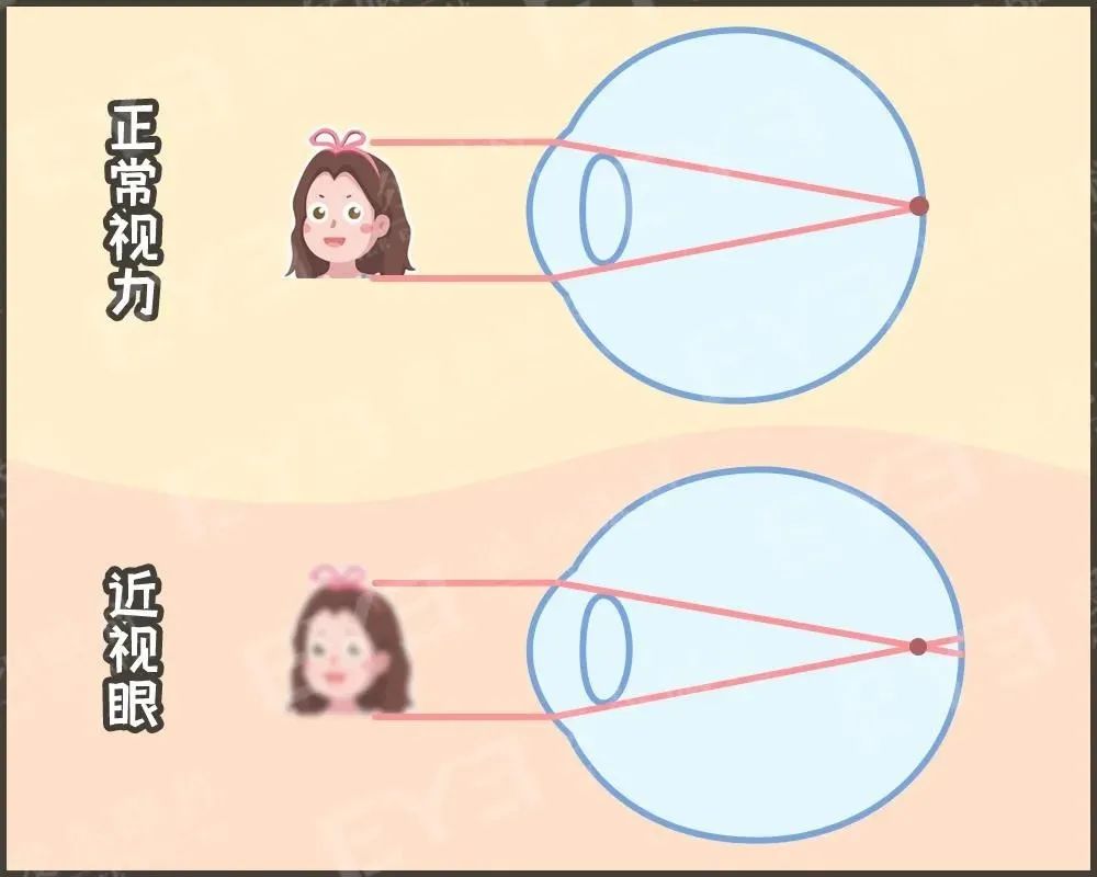 【冷知识】刘海太长，可能会伤害到眼睛？插图(1)