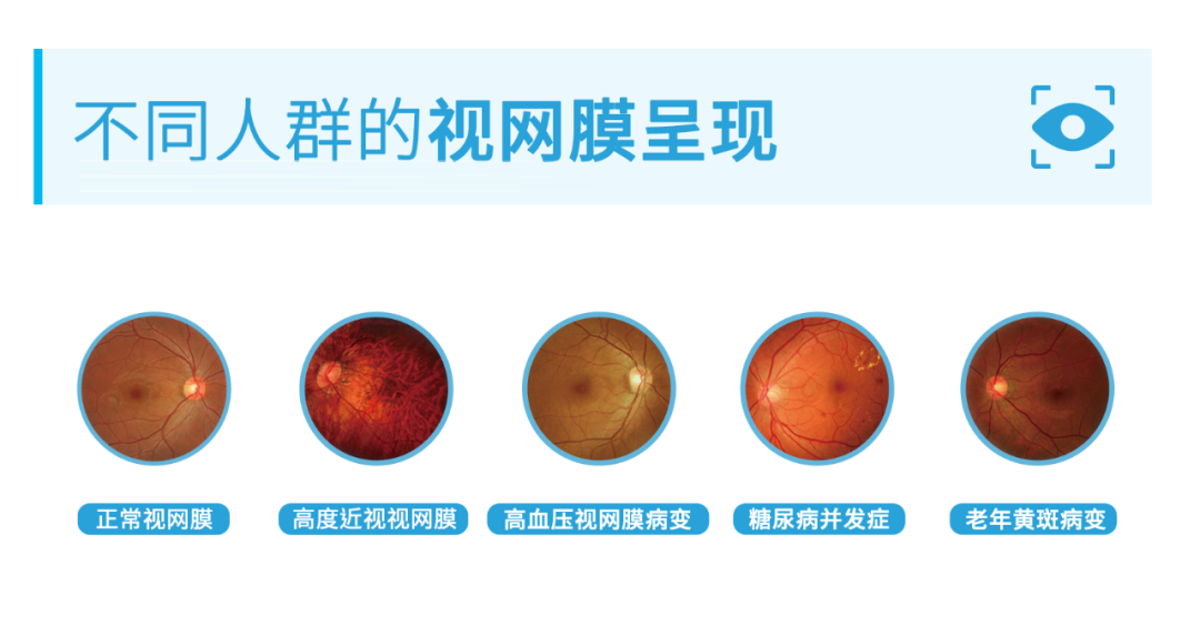 眼底检查到底有多重要？插图(1)