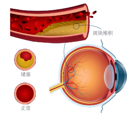 眼底检查到底有多重要？插图(3)