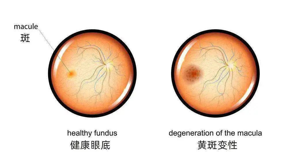 眼底检查到底有多重要？插图(4)