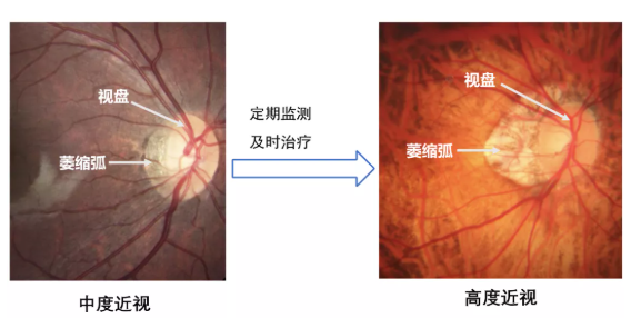 眼底检查到底有多重要？插图(5)