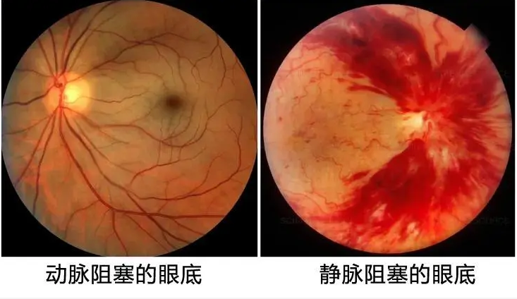 眼底检查到底有多重要？插图(6)