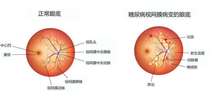 眼底检查到底有多重要？插图(7)