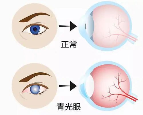 眼底检查到底有多重要？插图(8)